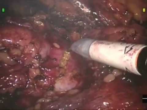 Robotic-Assisted Partial Nephrectomy