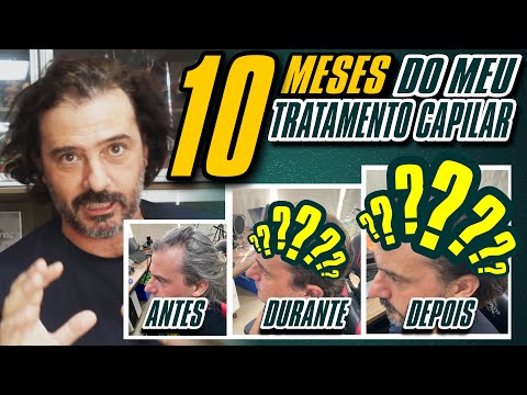 10 MESES DO TRATAMENTO MANUAL de QUEDA DE CABELO | FUNCIONA MESMO pra HOMENS e CALVÍCIE MASCULINA?