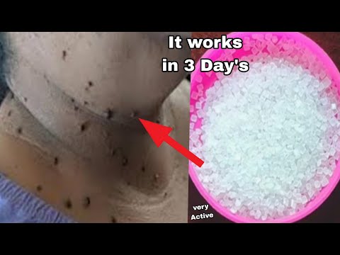 diy skin tag removal in 3 day  / skin tag removal natural remedies with lemon remedy 💞