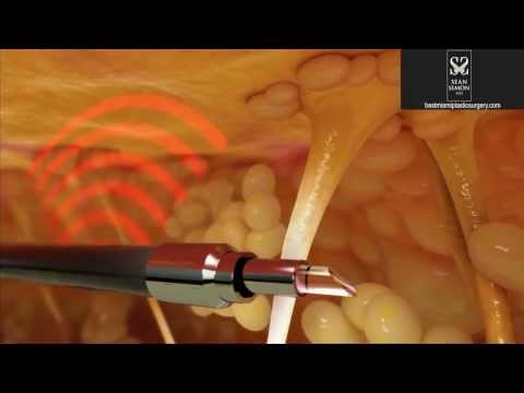 Dr. Sean Simon Plastic Surgery Miami - Miamilaserfacelift.com