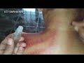 PIJIT PAKE COIN INDONESIA TRADITIONAL CURE FOR SICKNESS Pake Minyak GPU