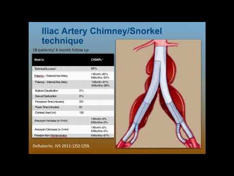 Preserving Hypogastric Flow: Branched Iliac Stent Grafts - Steve Henao, MD