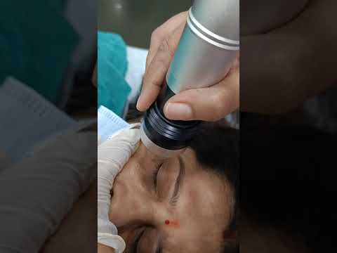 Dark circles treatment by MNRF technology.. Message me  99908 04088.