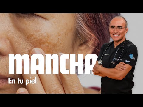 Goodbye Melasma! How to remove spots and blemishes from the face