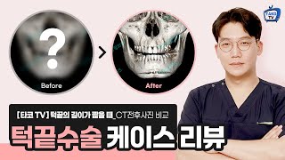 [타코TV]케이스리뷰_#01 턱끝 T절골, 길이 연장 후 시간이 지나면 어떻게 될까?(엉덩이턱,  비대칭턱 안면윤곽수술)
