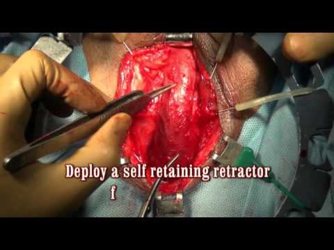 Uretroplastyka: mobilizacja cewki 