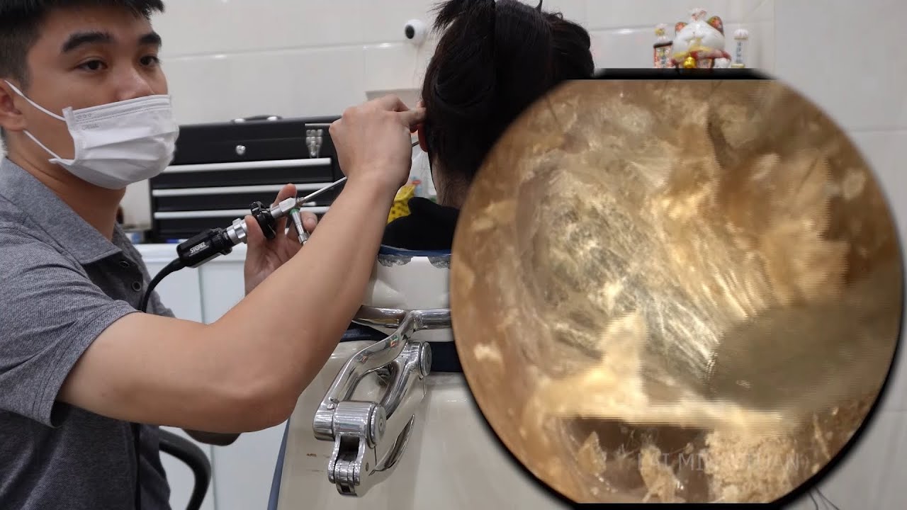 👂💤 耳かき | 耳掃除 | 長期間の耳掃除不足による耳垢の詰まり 💖 DR. LAI MINH TUAN