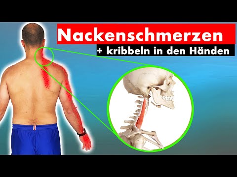 Cervical spine syndrome ► ► This muscle is to blame (DO NOT STRETCH!) | Cause & solution through ...