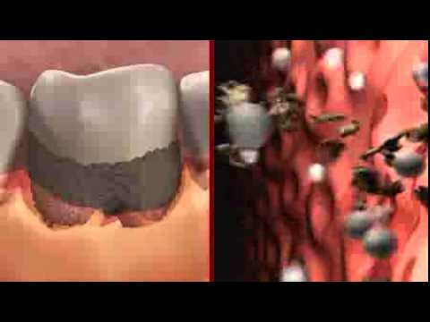 Gingivite, parodontite : maladies des gencives