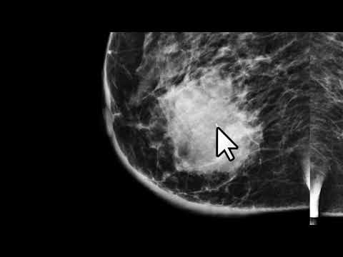 Marcação do câncer de mama com clipe de titânio nos casos em que o tratamento começa com a químio.