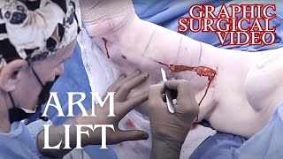 Extended Arm Lift (Forearm Reduction) on 62 y/o Female Patient
