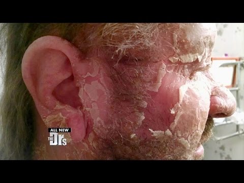 Aiuti a guarire la dermatite atopic al bambino È possibile andare a un bagno a eczema