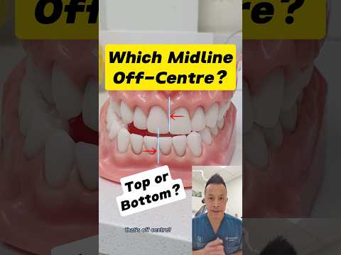 Is Your Top or Bottom Dental Midline Off-Center? How to Tell! #dentallan #dentist #shorts