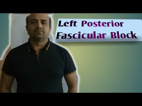 ECG....Left Posterior Fascicular Block(LPFB)