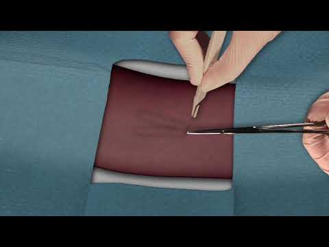 Family Planning How to Remove Implant