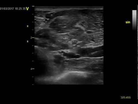 Anterior interosseous enlargement at pronator exit. Nerve ultrasound.