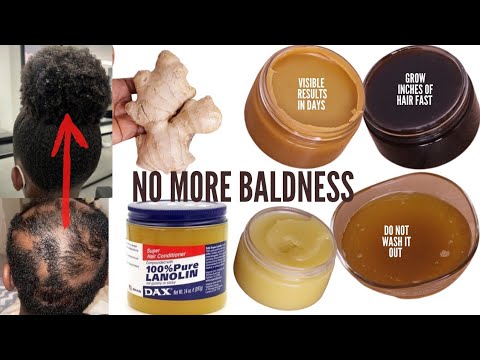 MIX GINGER & DAX POMADE TO GROW BACK ALOPECIA.BALDNESS SHEDDING 3 TIMES UNSTOPPABLE FASTER