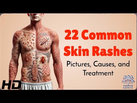 22 Skin Rashes Everyone Should Know About: Symptoms & Treatments
