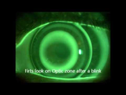 Fluorescein exam protocol DRL M