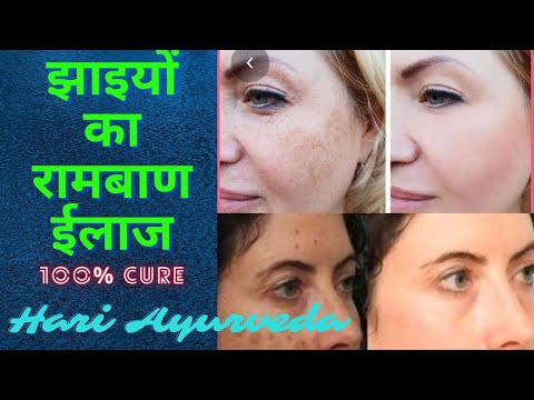 Hari ayurveda herbal melasma anti pigmentation cream, type o...