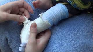 How to remove a fiberglass and plaster cast from an infant