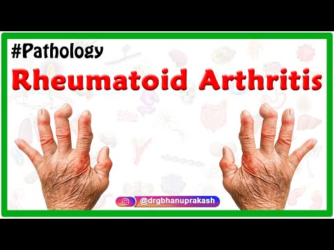 Deformálódó artrózis és kezelése