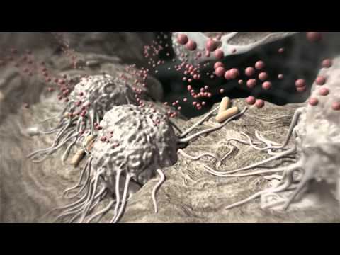 Haben Prostatitis ist mit niedrigen Rückenschmerzen Operation an der Prostata-Adenom in Israel