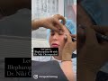 Watch a blepharoplasty being performed #shorts