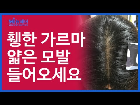 휑한 가르마, 머리카락 얇은 여자분들 들어오세요 l 우리끼리 탈밍아웃 l 뉴헤어 [모발이식][모발이식후기]