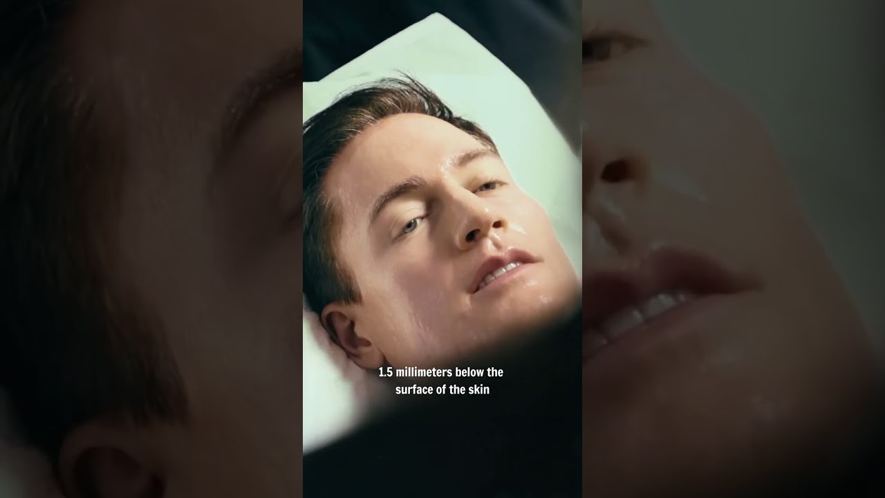 Trying Sofwave for skin rejuvenation with Project Babyface. No needles, no downtime.