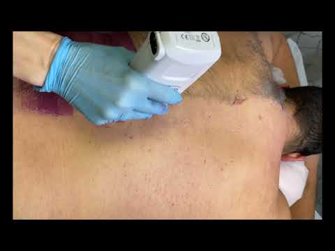 Full Back Waxing Hair Removal for Men. Clearwater Wax Services