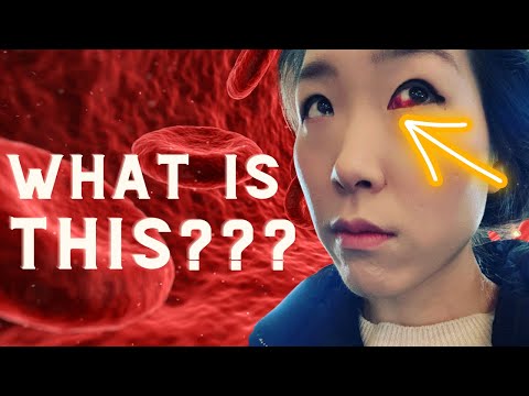 Did You Wake Up With A Bloody Eye??? | It Might Be A Subconjunctival Hemorrhage!