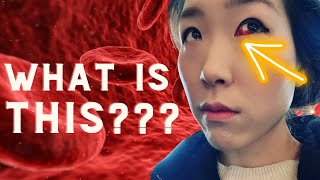 Did You Wake Up With A Bloody Eye??? | It Might Be A Subconjunctival Hemorrhage!