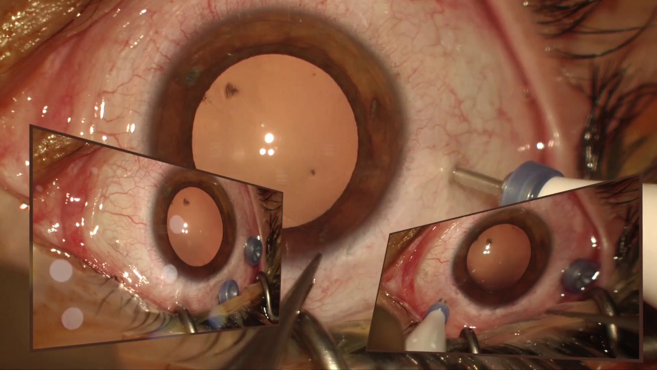Watch video Corps étranger intra oculaire Corps étranger intra oculaire