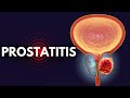 Prostatitis Demystified From Diagnosis To Relief