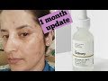 I Tried The Ordinary Niacinamide 10 Zinc 1 For My Acne Scars For 1 Month REVIEW Rachna Jintaa