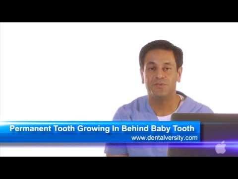 Permanent Tooth Growing In Behind Baby Tooth
