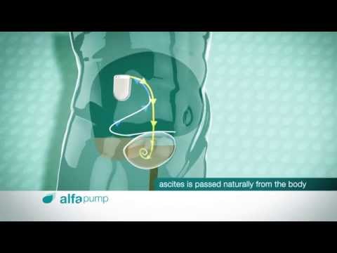 alfapump System with DirectLink Technology