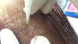 FUE Hair Transplantation unshaven - Dr. Anastasios Vekris (video)