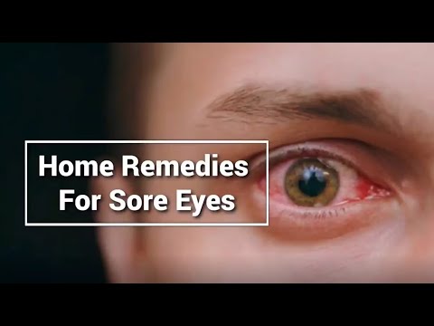 Home Remedies For SORE EYES TREATMENT | Best treatment of Sore Eyes Naturally |