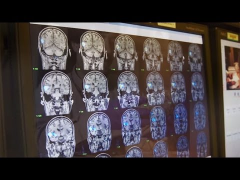 Alzheimer's Disease Research at Rush