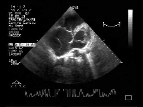 Atrial Septal Defect With Chiari Network (1)