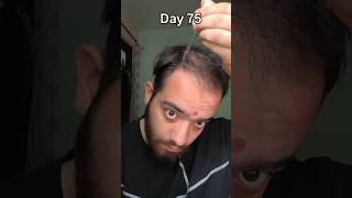 Download lagu Day 75 Using minoxidil till I recover my hairline #minoxidil #minoxidil5 mp3
