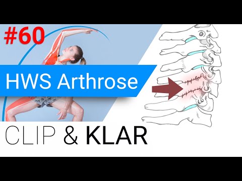 HWS Arthrose erklärt - Verschleiss in der Halswirbelsäule
