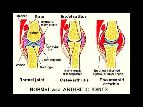 Bei wunden unteren Rücken am Morgen Verschiebung des Halswirbels bei Osteochondrose