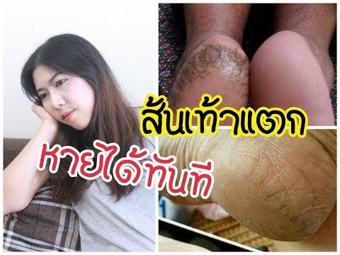 โรคสะเก็ดเงินเกลือทะเล การรักษา SDA วงจรกลาก