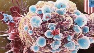 Killer 'sticky balls' may stop cancer spreading