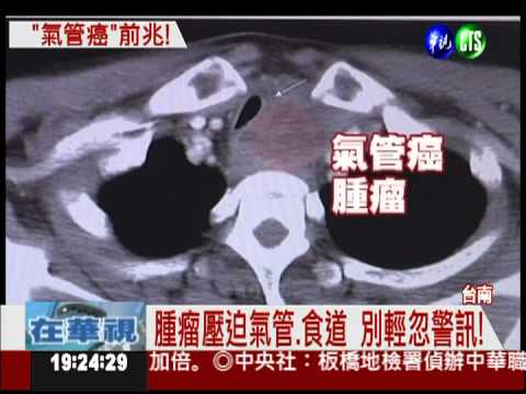 聲音沙啞又易嗆 竟是罹氣管癌