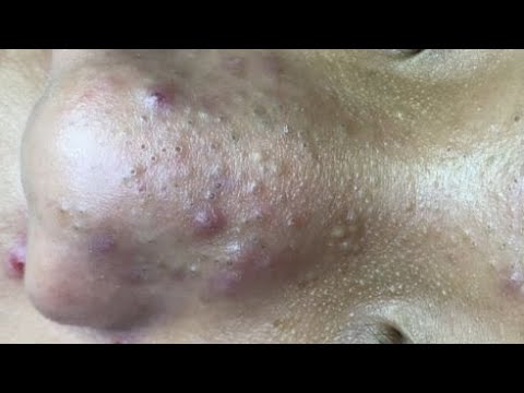  ASMR Deep Facial Cleansing for Clear Skin | Acne, Blackheads & Whiteheads#asmr 