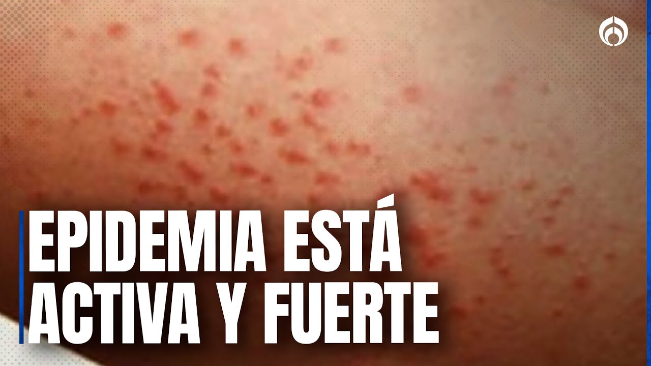 Brote de sarampión en México está sin control, asegura especialista